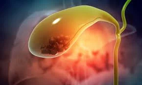 Gallbladder Stones Surgery Lucknow