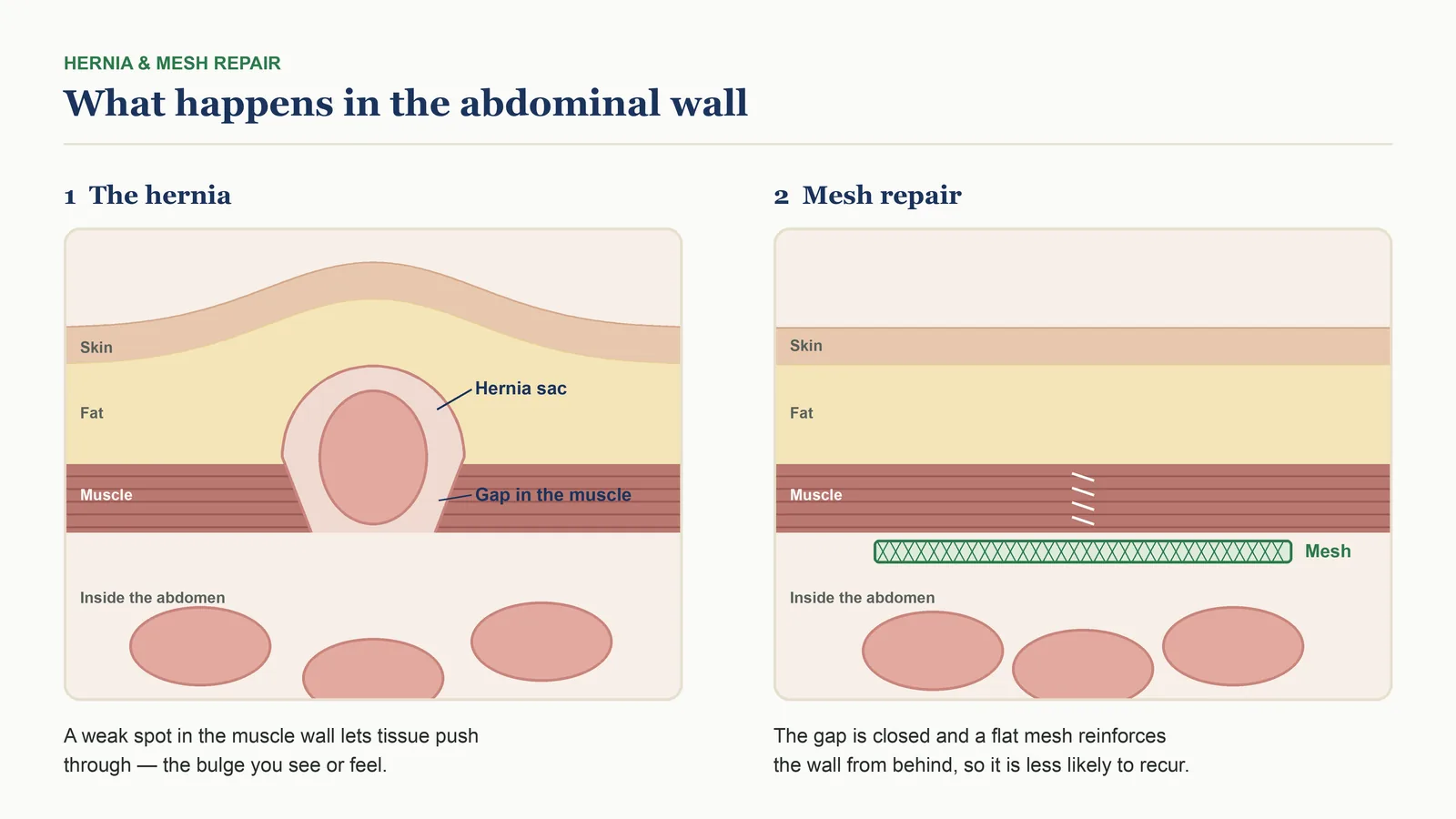 Diagram for hernia surgery in Lucknow: a hernia pushing through a gap in the abdominal muscle wall, and the same wall after mesh repair